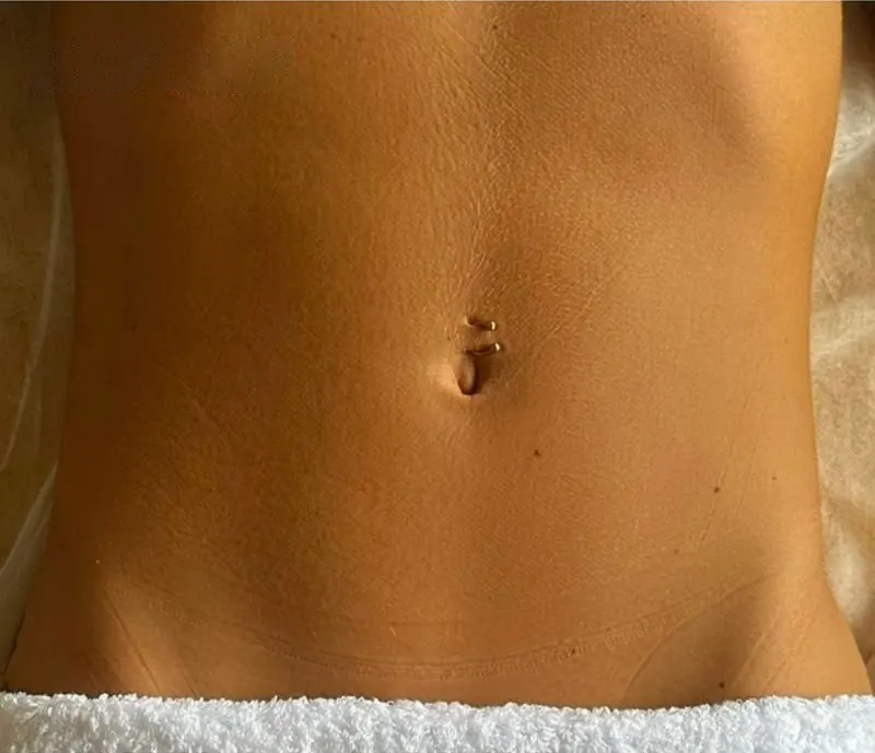 Abdomen before treatment